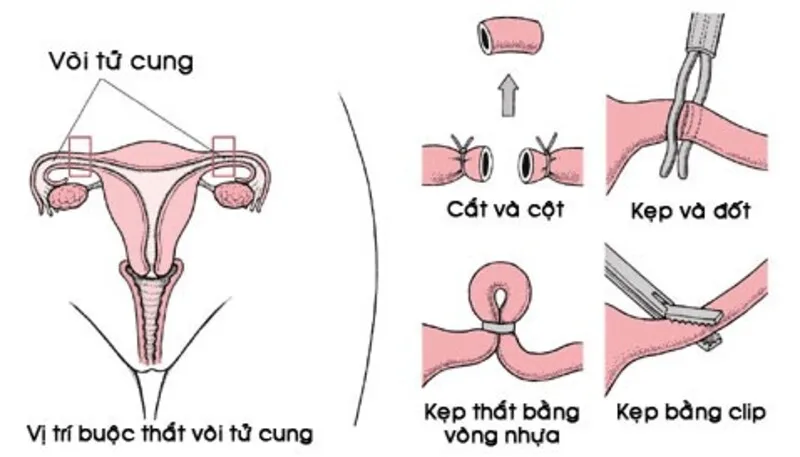 Quá trình thực hiện và phục hồi sau thắt ống dẫn trứng (Nguồn: Internet)
