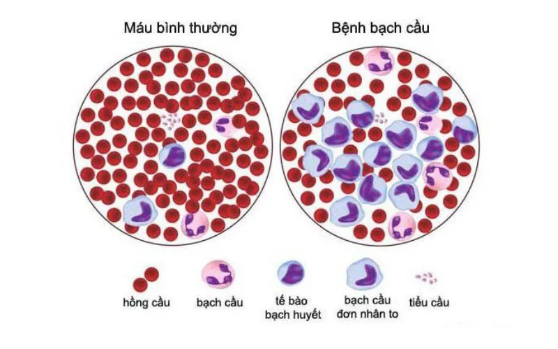 Bệnh Leukemia là gì là thắc mắc của rất nhiều người (Nguồn: Internet)