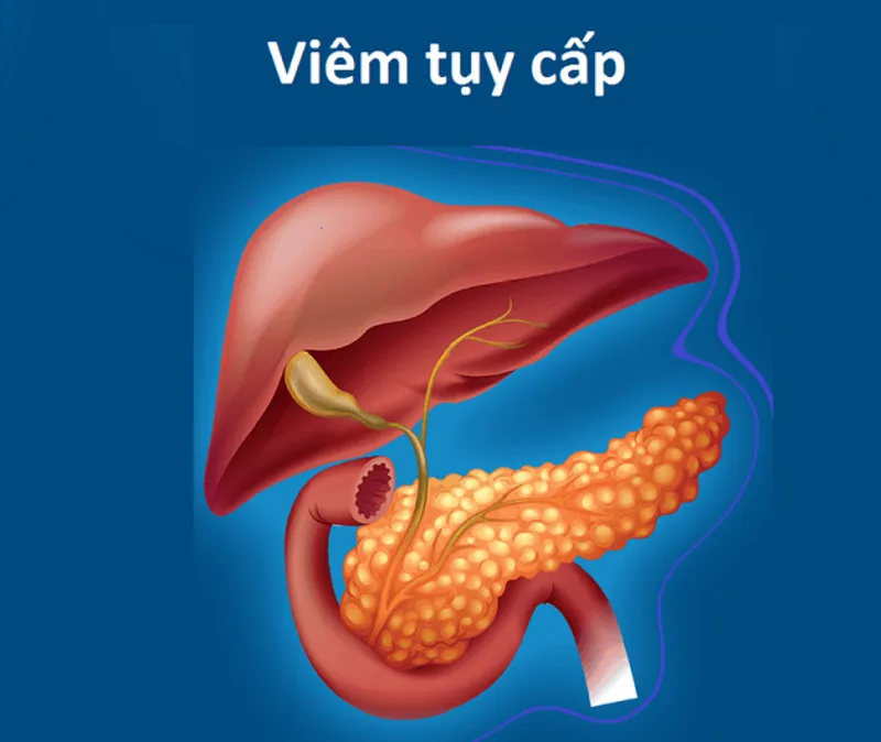 Viêm tụy cấp có phải mổ không? (Nguồn: Internet)