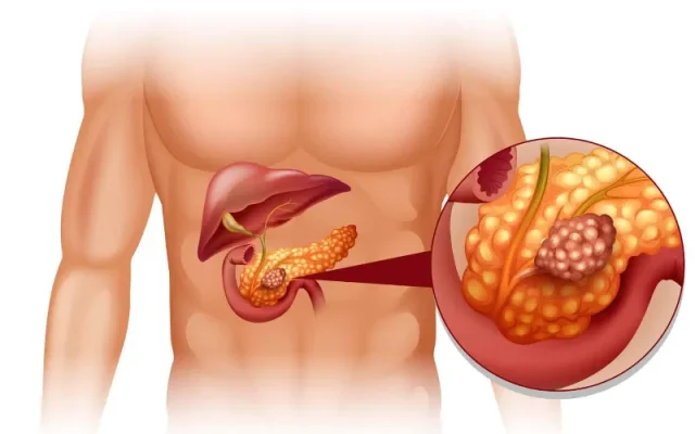 Khi nào viêm tụy cấp cần phẫu thuật? (Nguồn: Internet)
