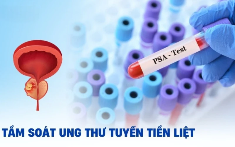 Lợi ích khi chọn bệnh viện tầm soát ung thư tuyến tiền liệt tốt nhất Singapore (Nguồn: Internet)
